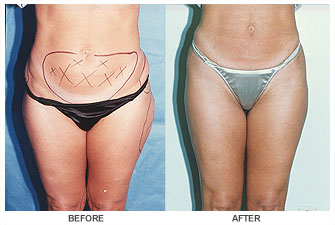 liposelection_ba01