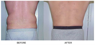 liposelection_ba03