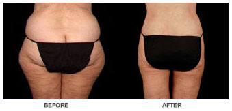 liposelection_ba04