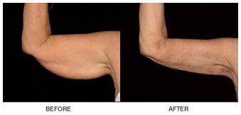 liposelection_ba05
