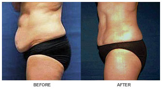 liposelection_ba10