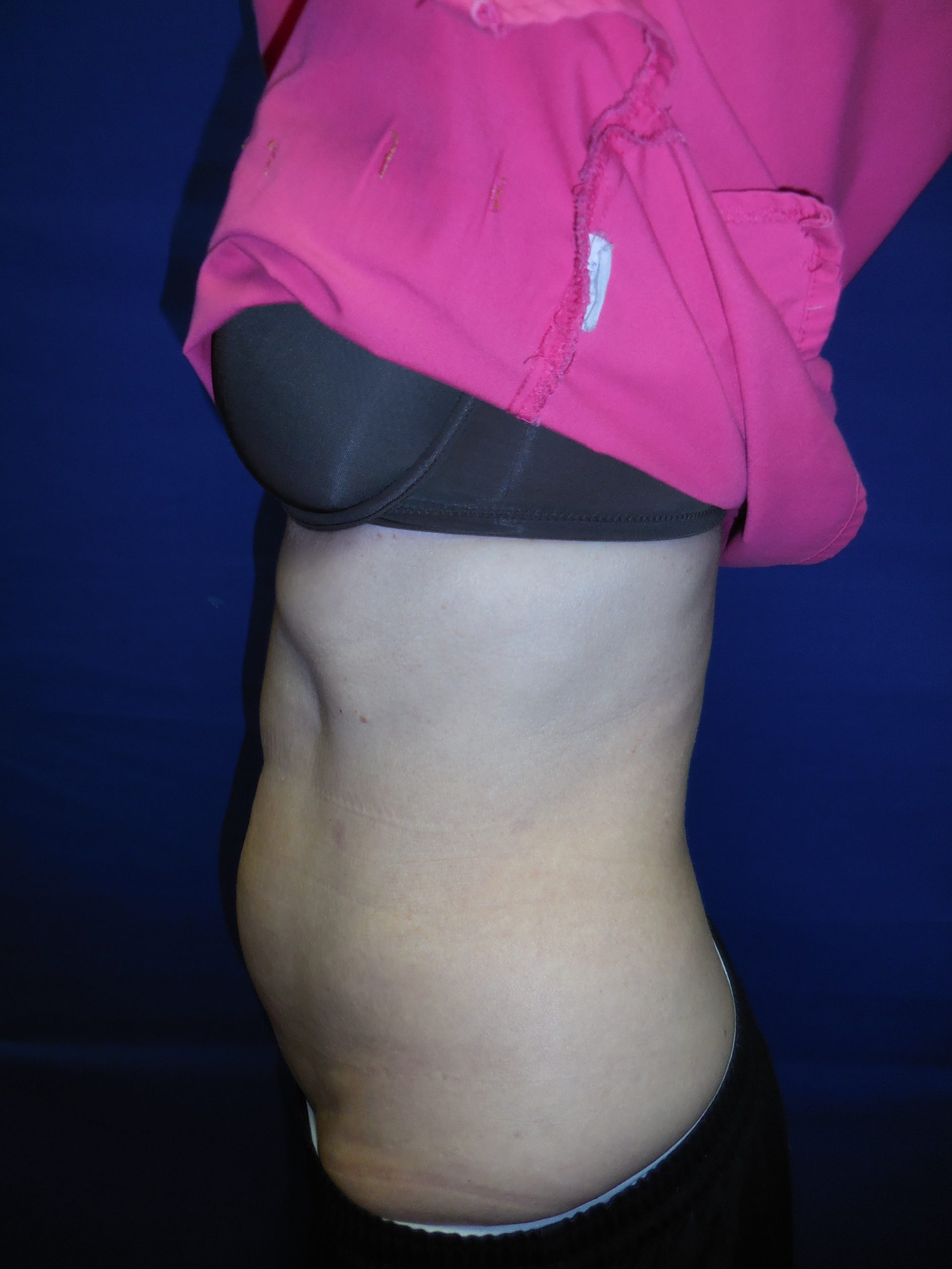 ULTRASHAPE VS. COOLSCULPTING Cascades Med Spa