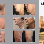Morpheus8 RF Micro-Needling Orlando Florida